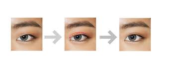 Safely remove blackheads in five easy steps: Asian Double Eyelid Cosmetic Surgery Stanford Medicine