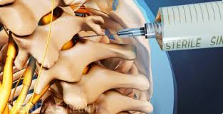 Image result for Lower Cervical Intramuscular Injection