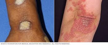 Image result for psoriasis