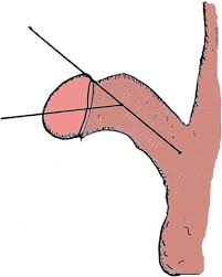 Image result for Chordee