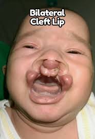 Operasi Bibir Sumbing pada Bayi 3 Bulan