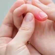 Image result for Akutní zánět nehtového lůžka