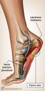 Fasciitis Plantaris Hielpijn Voeten Voeten Behandeling