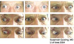 Eyerounds Org Thyroid Eye Disease Graves Ophthalmopathy