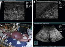 Autosomal Recessive Polycystic Kidney Disease Arpkd In Neonates A Download Scientific Diagram