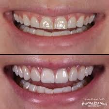 In today's blog, your newhall, ca, dentist is taking about everything you need to know about our porcelain veneers! My Veneers Story See My Dramatic Before And After Photos Allure
