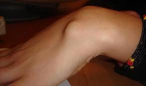 1,433 likes · 35 talking about this. Kyste Synovial Pourquoi Cette Boule Au Poignet Passionsante Be