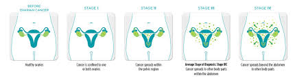 Women may experience constipation, bloating, early satiety after her wife was diagnosed with ovarian cancer within weeks of their wedding. Ovarian Cancer Physiopedia