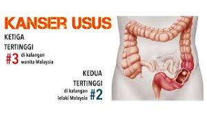 Tahukah anda kanser usus adalah kanser nombor 1 paling tinggi dalam kalangan lelaki? Apa Itu Kanser Usus Punca Kanser Usus Tanda Awal Kanser Usus Cara Cegah Dan Rawat Kanser Usus Youtube