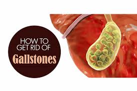 Gallstones may cause no signs or symptoms. Why Is Gallstone Common In Women And At What Age Is It Most Likely International Surgery Rome
