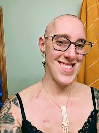 Embracing new look after chemo