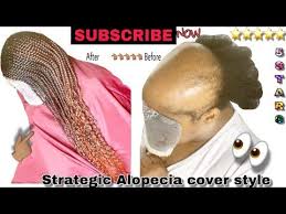 64 Serious Alopecia Transformation Youtube Alopecia Hair Gurus Hair Skin