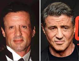 For years, he had tried different methods to conceal the hair loss, including a combover style, but as the hair loss progressed, these methods simply weren't enough anymore. Celebrity Hair Transplant Top 11 Celebrities Surgery