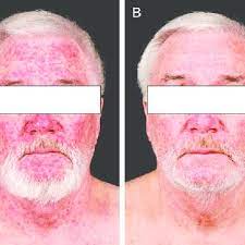 I am interested to hear from anyone who has been on irinotecan and your experiences of hair loss and how you managed it. Acneiform Rash In A 68 Year Old Patient Treated With Cetuximab And Download Scientific Diagram
