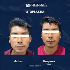 ✨ Increíbles Resultados con Otoplastia ✨ 🔹 Transforma la apariencia de tus  orejas y recupera tu confianza 🔹 Procedimiento realizado por el Dr. Ulises  Solís, cirujano plástico especializado 🔹 Observa el cambio