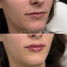 Once that lip flip kicks in + swelling and small hematomas heal this  creation is going to be 👌🏽👌🏽👌🏽 Wanna see the full result at two  weeks?! I'm reeeaaally loving pairing lip