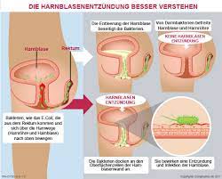 Escherichia coli (/ˌɛʃəˈrɪkiə ˈkoʊlaɪ/), also known as e. Blasenentzundung Symptome Behandlung