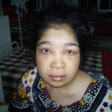 A Sample of Intraoral View (Mandibular Left Side) Following Dental...