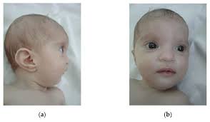 Wolf-Hirschhorn Syndrome: Clinical and Genetic Study of 7 New Cases, and  Mini Review