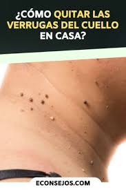 8 Formas Naturales Para Quitar Las Verrugas Del Cuello En 2020 Como Quitar Verrugas Remedios Para Verrugas Remedio Para La Piel Casero