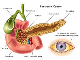 Pancreatic cancer (cancer of the pancreas) mainly occurs in people aged over 60. 6 Early Warning Signs Of Pancreatic Cancer You Should Know Women Daily Magazine