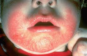 Image result for red rash face