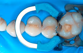 Image result for Occlusal