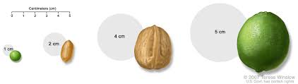 A painless lump or swelling on either testicle. Testicular Cancer Treatment Pdq Patients Siteman Cancer Center