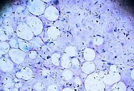 Image result for Liposarcoma