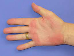 Pe can exist as a primary physiologic finding or as a secondary marker of systemic pathology. Palmar Erythema Dermnet Nz
