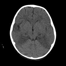 Its symptoms are fever, confusion, coma, and seizures. Hsv Encephalitis Radiology Case Radiopaedia Org