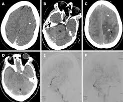 Hanprasertpong t., hanprasertpong j., riabroi k. Cerebral Venous Sinus Thrombosis Following Transsphenoidal Surgery For Craniopharyngioma A Case Report