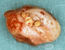 Image result for Tonsillolith