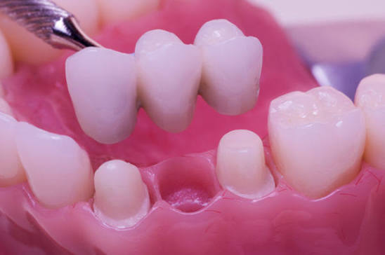 Crown, Veneers & Bridge