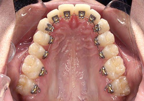 Lingual Braces product image