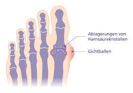 Hyperurikamie Gelenk Klinik De