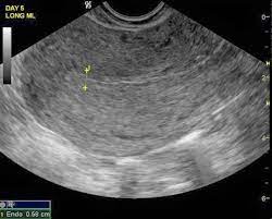 The Endometrial Lining Is Thin And Early Proliferative Phase Note The Distinct 3 Lines Or Trilaminar Appearance Lines Notes Uterus