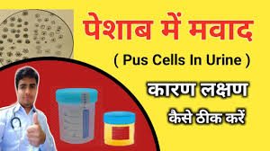 यूरिन में पस सेल्‍स कितना होना चाहिए? डॉक्टर से जानें इसकी नॉर्मल रेंज | Pus  Cells In Urine Normal Range In Hindi | Onlymyhealth