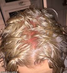When you dye your hair at home without precautions you. Lancashire Student 19 Left With Chemical Burns After Hairdresser Left Bleach On For Hour And A Half Daily Mail Online