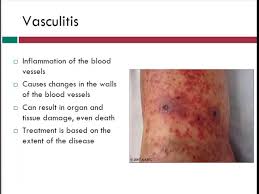 Image result for Vasculitis