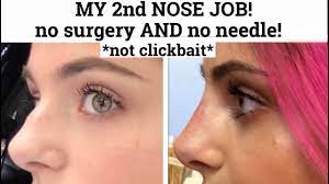 My Second Non Surgical Nose Job No Surgery No Needle Not Clickbait Nose Job Nose Fillers Nose