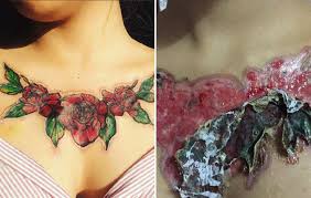 It is free of dyes, fragrance, and preservatives, so it works just find for sensitive skin. Tattoo Removal Leaves Woman With Massive Scars Men S Health
