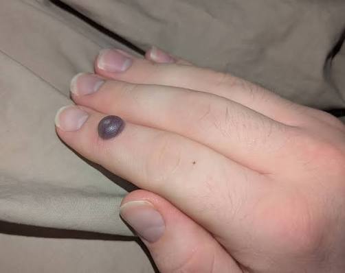 Painful blister after wart cryotherapy treatment