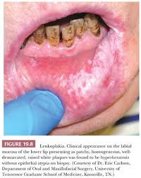 Image result for Labial mucosa