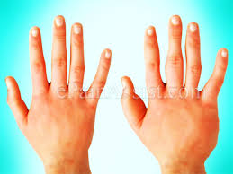 Pin On Rsd Crps Chronic Regional Sympathetic Complex Dystrophy