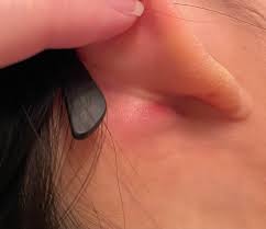 Hiện tượng nổi hạch sau tai tiềm ẩn bệnh l&yacute; nguy hiểm g&igrave;?