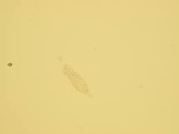 Image result for Urinary Cast