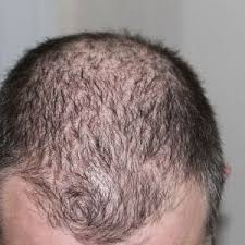 Pumpkin seed oil is packed with vitamins and minerals such as b1, b6, e, a, k and zinc which provide a huge benefit to hair regrowth. Pumpkin Seed Oil Hair Loss Magic Homemade Recipe Hair