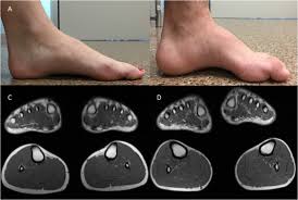 A progressive, degenerative condition that affects one or more joints especially of the foot or ankle, . A Very Mild Phenotype Of Charcot Marie Tooth Disease Type 4h Caused By Two Novel Mutations In Fgd4 Journal Of The Neurological Sciences