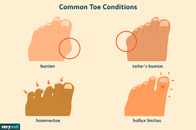 Common Toe Problems That Can Make Feet Look Abnormal common toe problems that can make feet